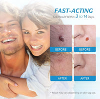 Skin Tag Remover Kit 2 In 1 For Micro To Large (2 Mm - 8 Mm  1 Set)