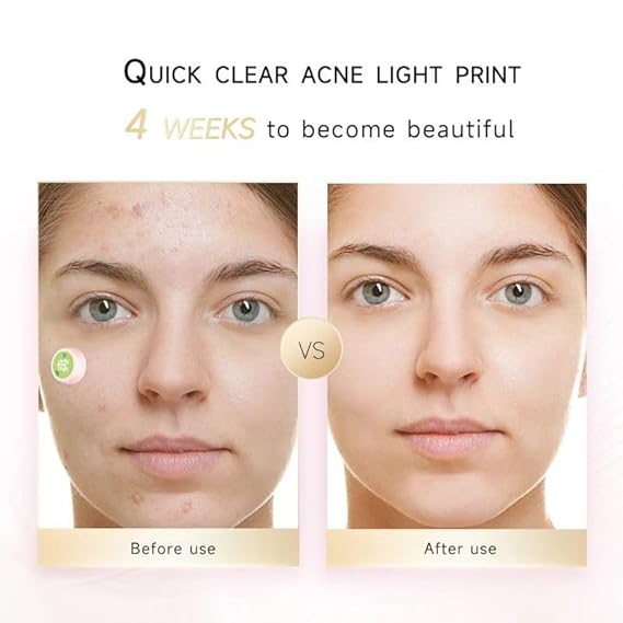 Electronic Acne Patches